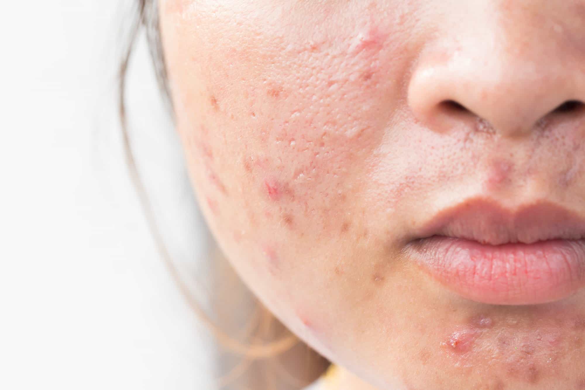 A common, often hormonally-triggered skin condition characterized by pimples and inflamed skin.