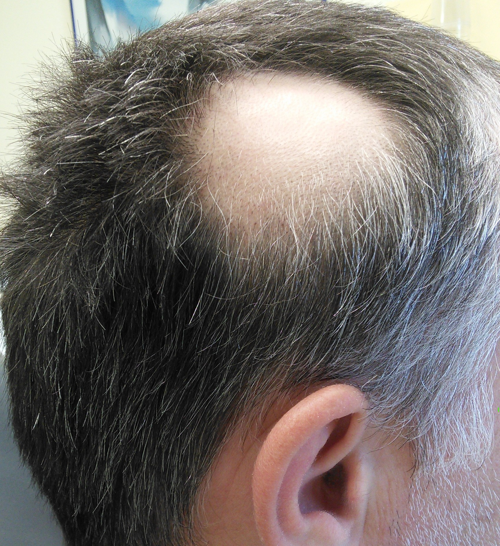 A condition causing hair loss in patches