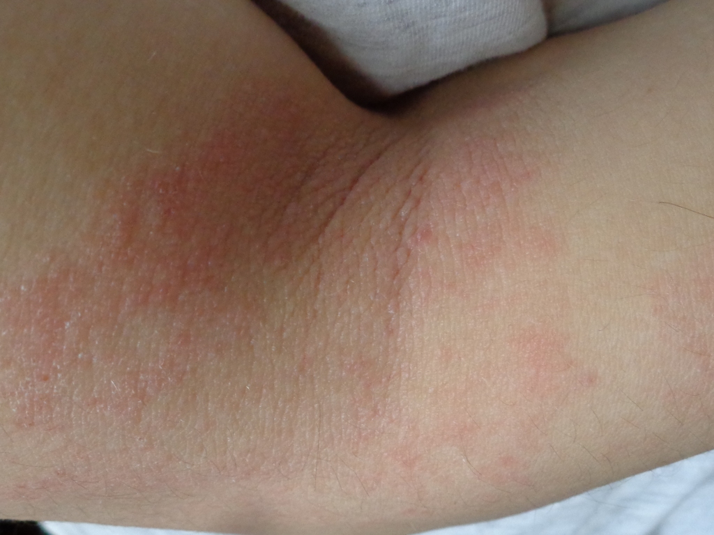 A common, non-contagious chronic skin condition creating itchy, inflamed skin