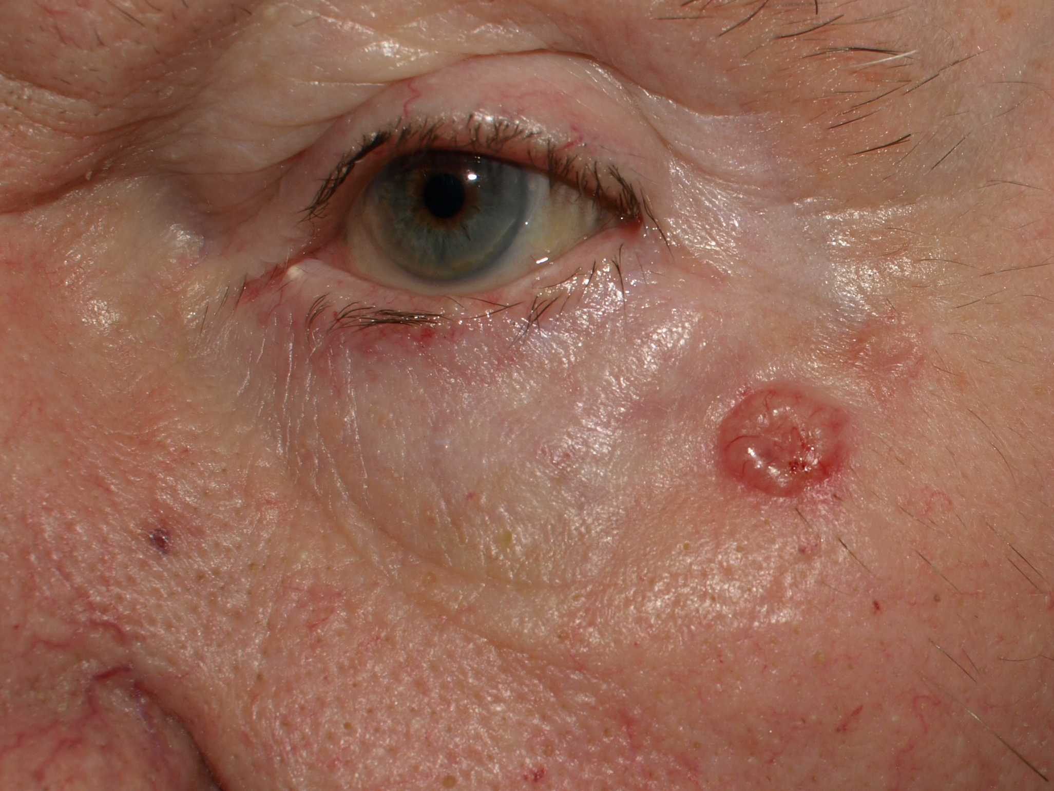 A common but highly treatable form of skin cancer