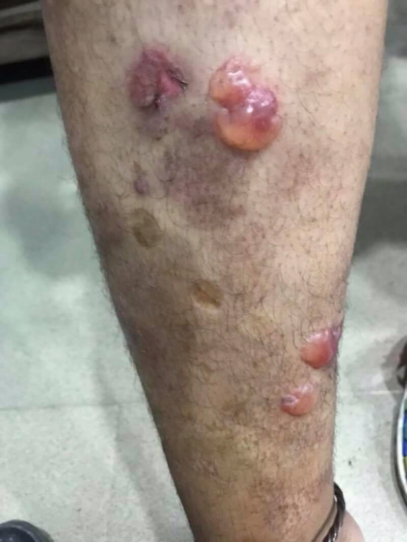 A rare, chronic autoimmune skin disorder causing large, fluid-filled blisters