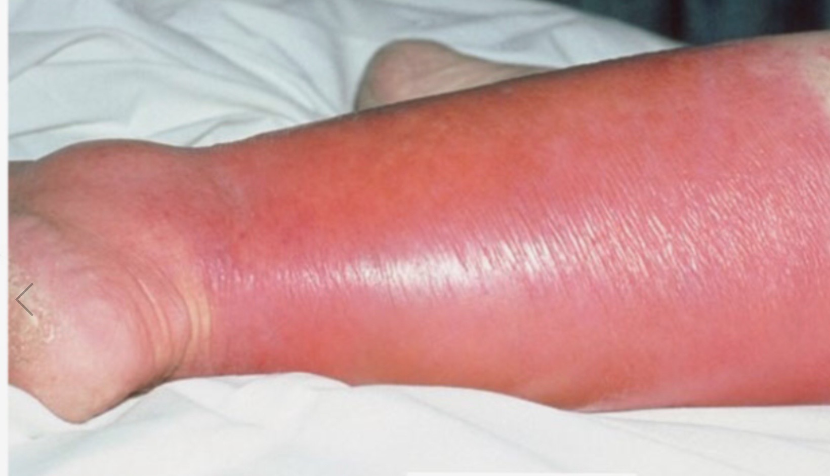 A common, potentially serious bacterial skin infection