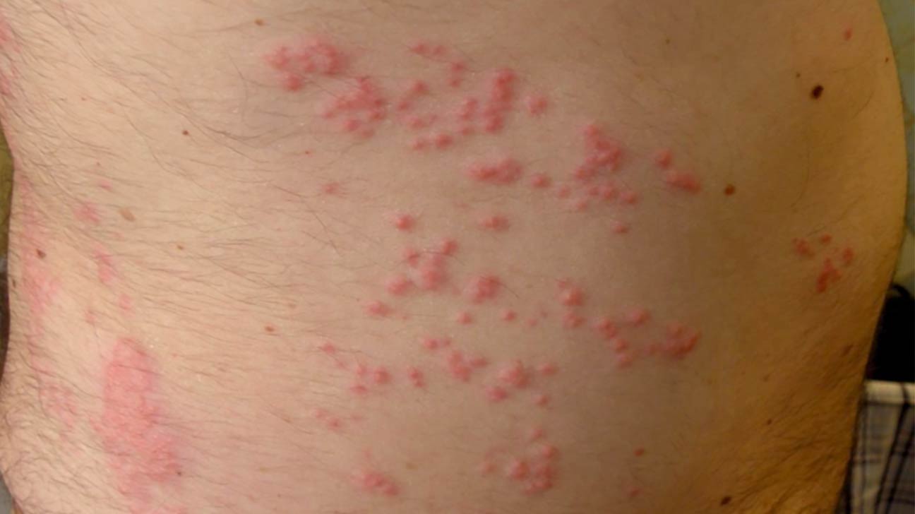 Also known as 'Swimmer's Itch', a skin condition caused by parasitic worm infection