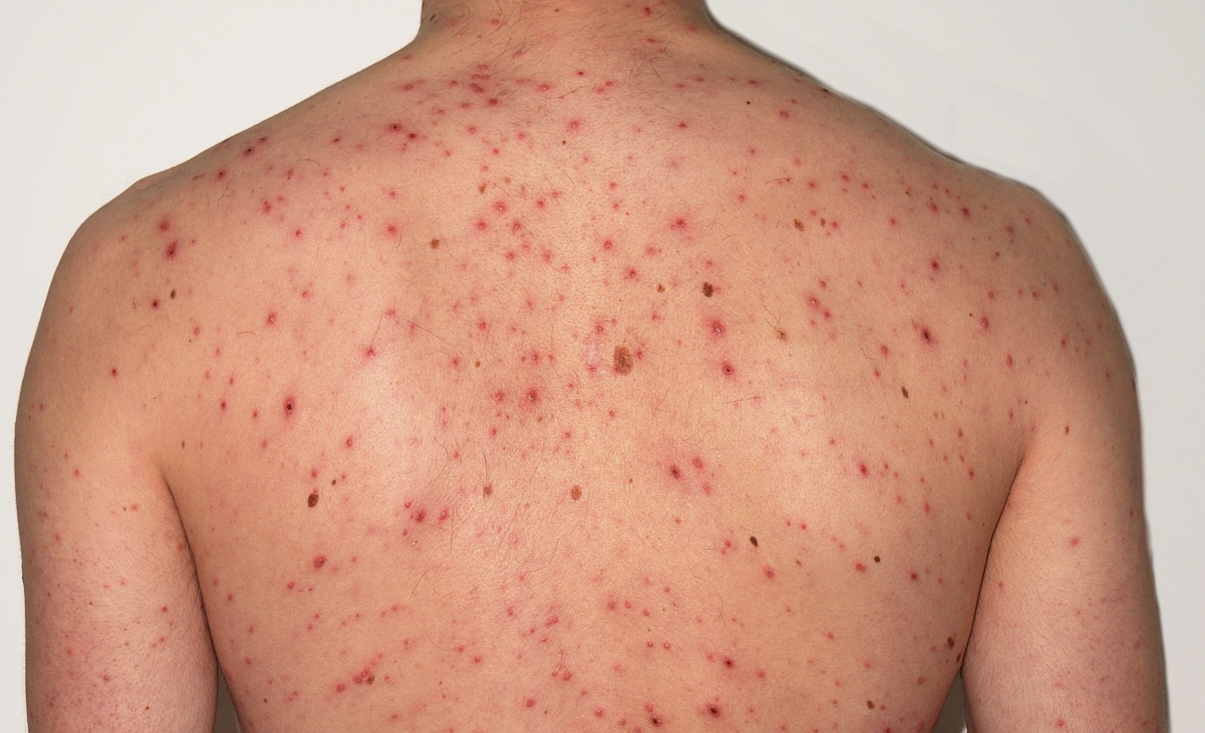 A highly contagious viral infection known for causing itchy, blister-like rashes