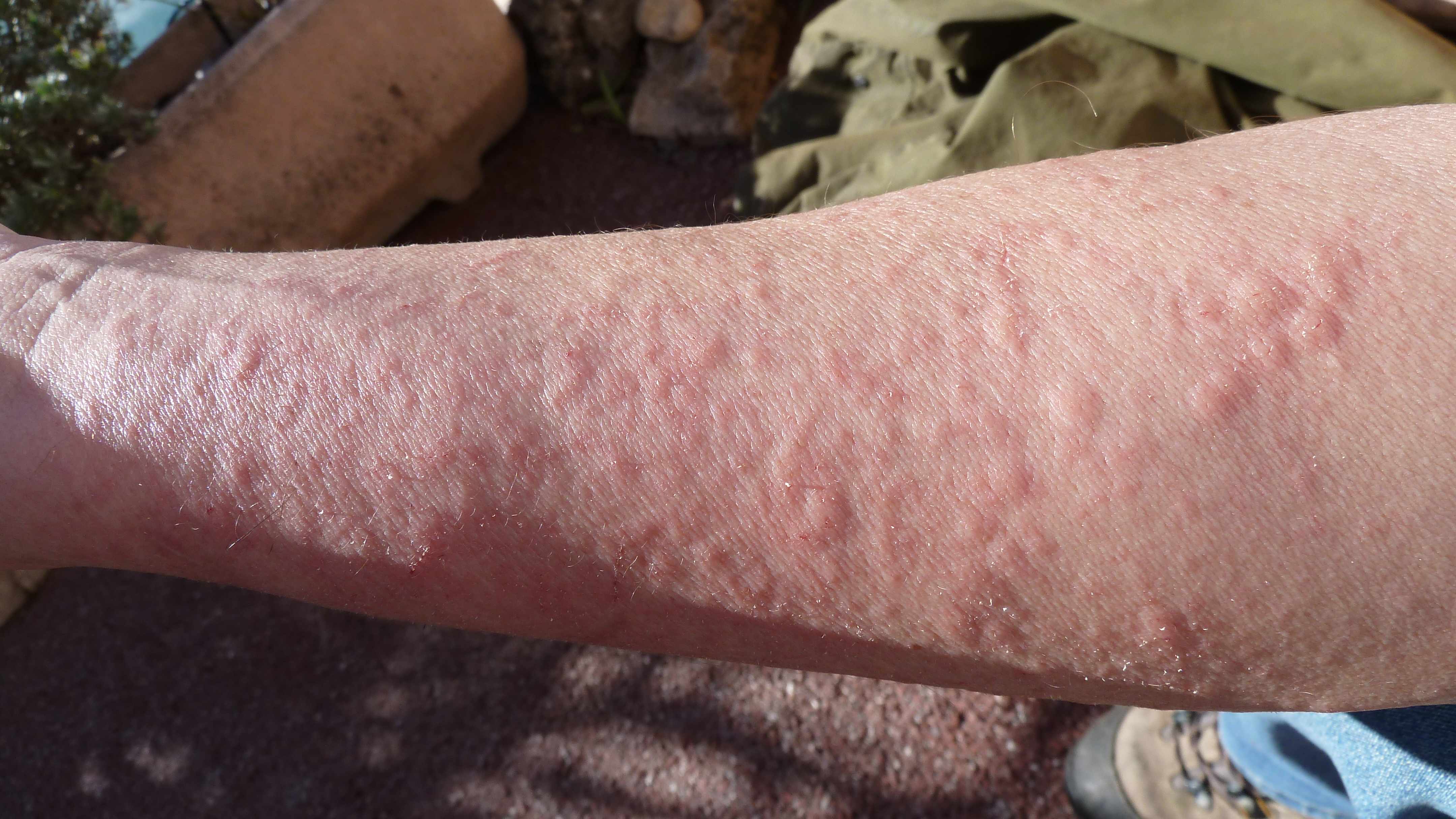 An itchy, inflamed skin reaction caused by direct contact with a substance