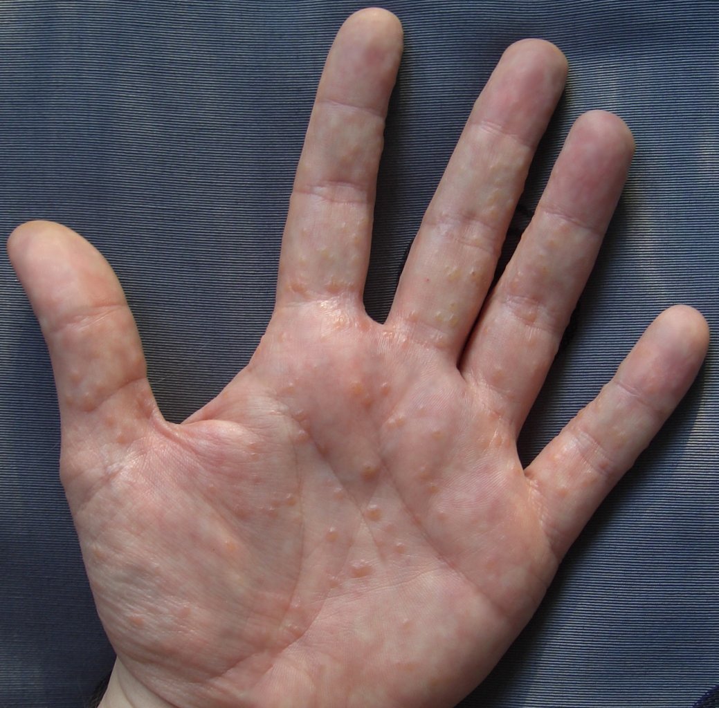 A chronic skin condition causing small, deep-seated blisters on the hands and feet