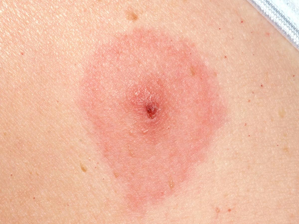 The early skin sign of Lyme disease, known for its characteristic 'bullseye' appearance.