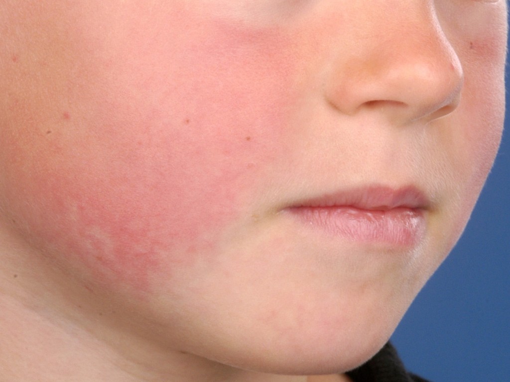 A mild viral illness causing a facial rash