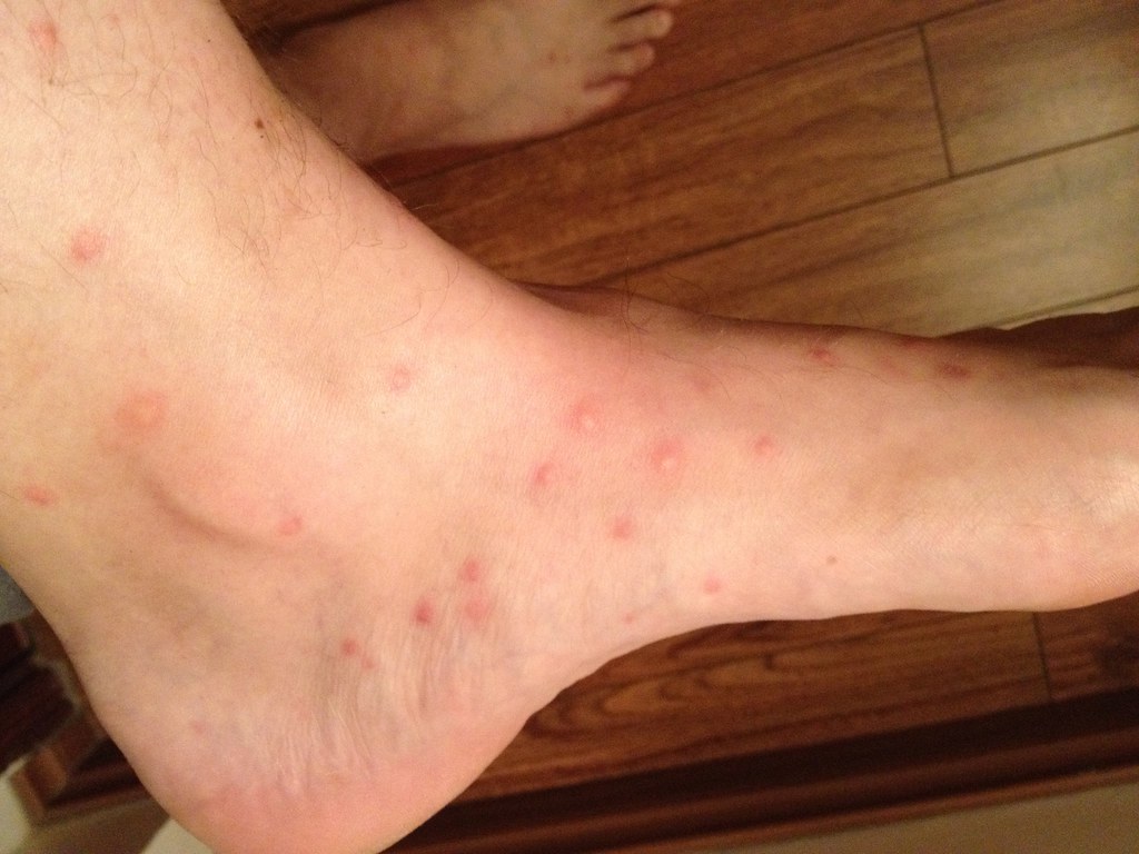 Irritating skin condition caused by bites from fleas