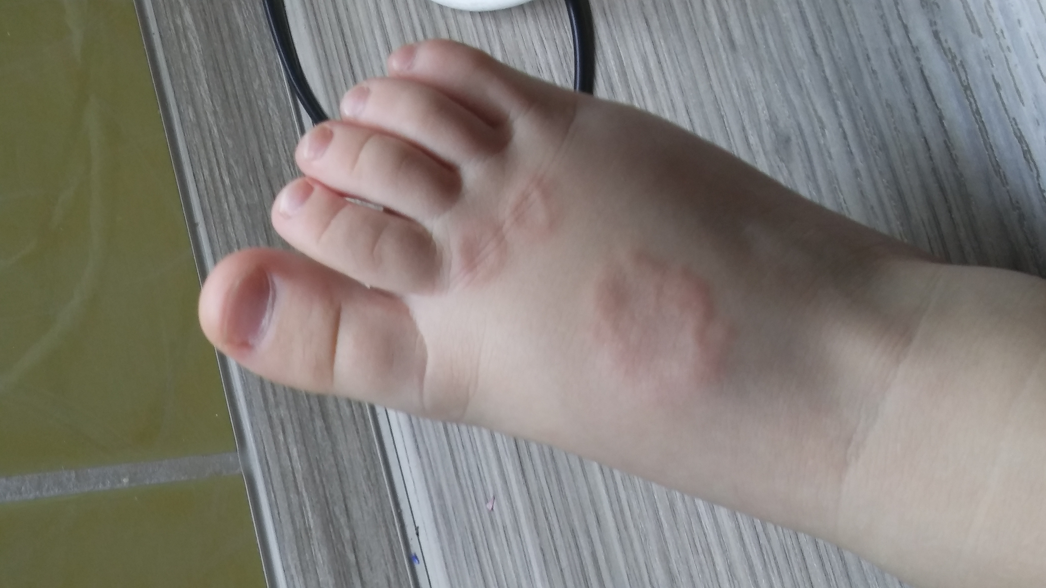 A benign skin condition that presents as ring-shaped patches on the skin