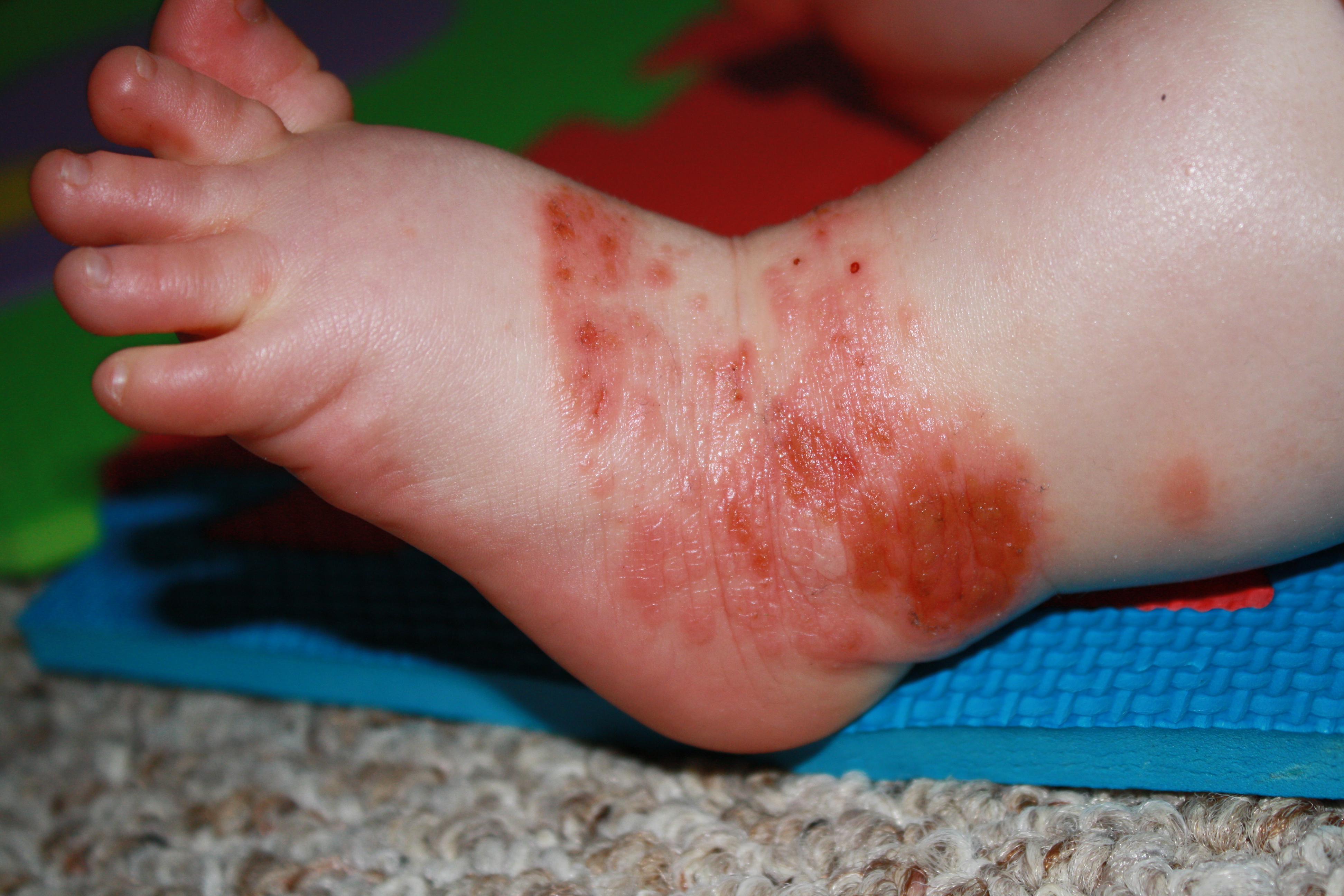 A common viral illness that mostly affects infants and children