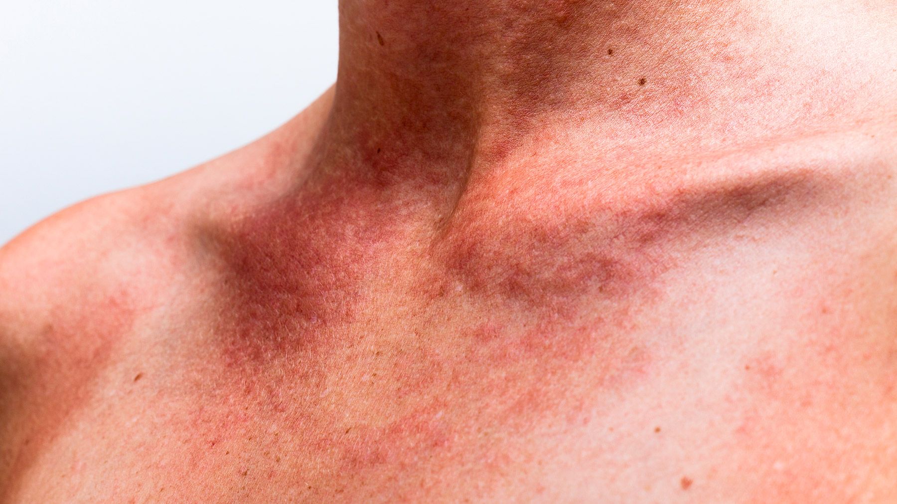 A common and mild skin irritation caused by excessive sweating in hot and humid weather