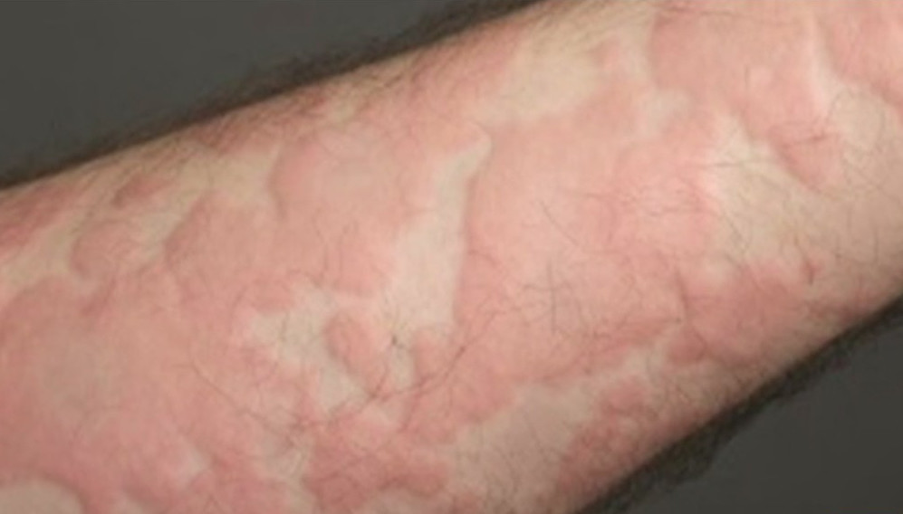 A skin condition characterized by red, swollen bumps or welts that appear suddenly