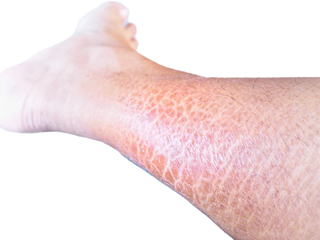 An inherited skin condition causing dry, scaly skin