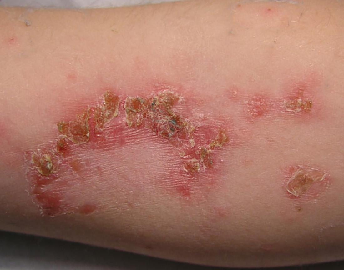 A highly contagious skin infection causing sores and blisters.