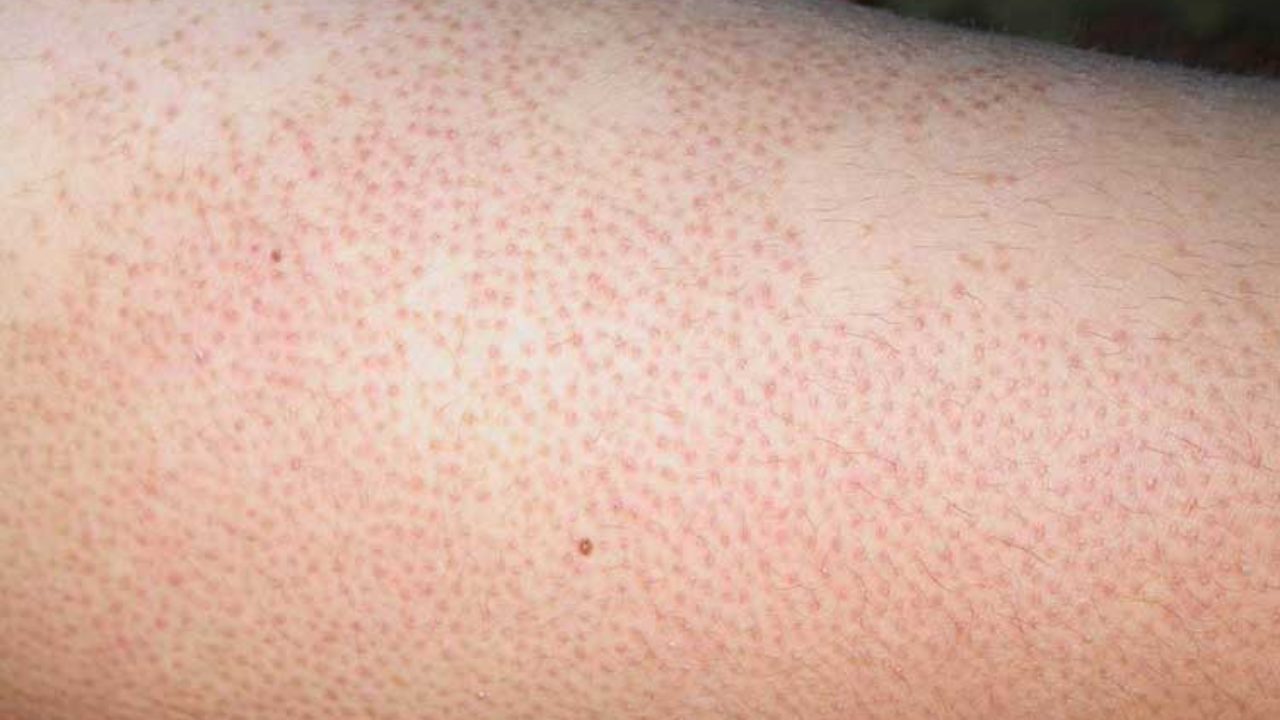 A common, harmless skin condition causing small, rough bumps, often on arms and legs