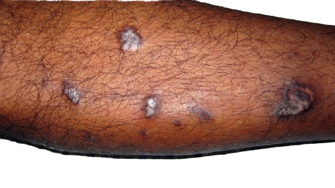 An inflammatory condition that can affect the skin, hair, nails, and mucous membranes