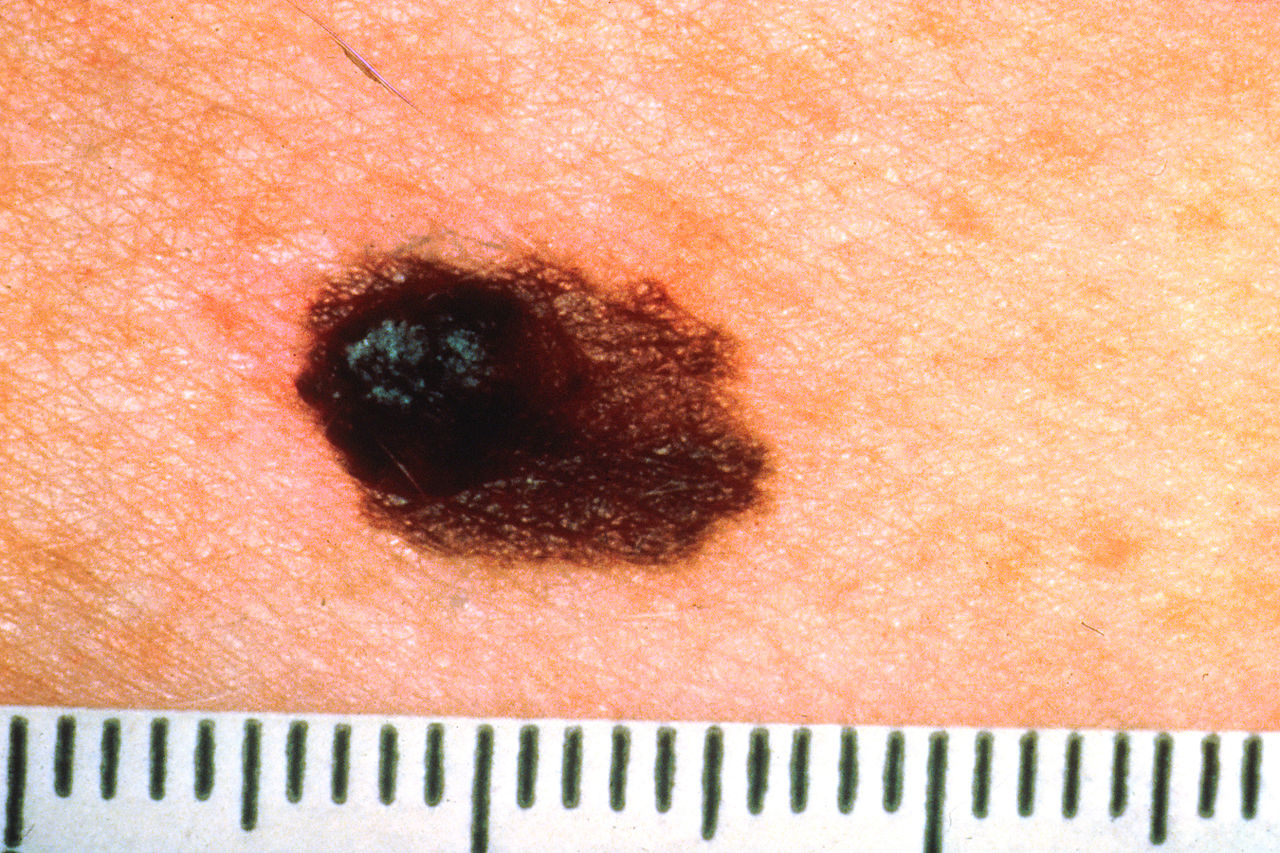 A type of skin cancer that can spread to other parts of the body