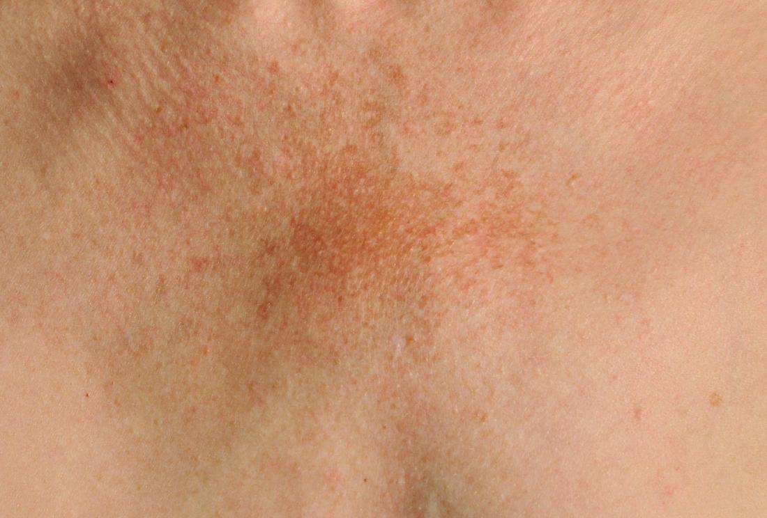 A common pigmentation disorder often referred to as the 'pregnancy mask'