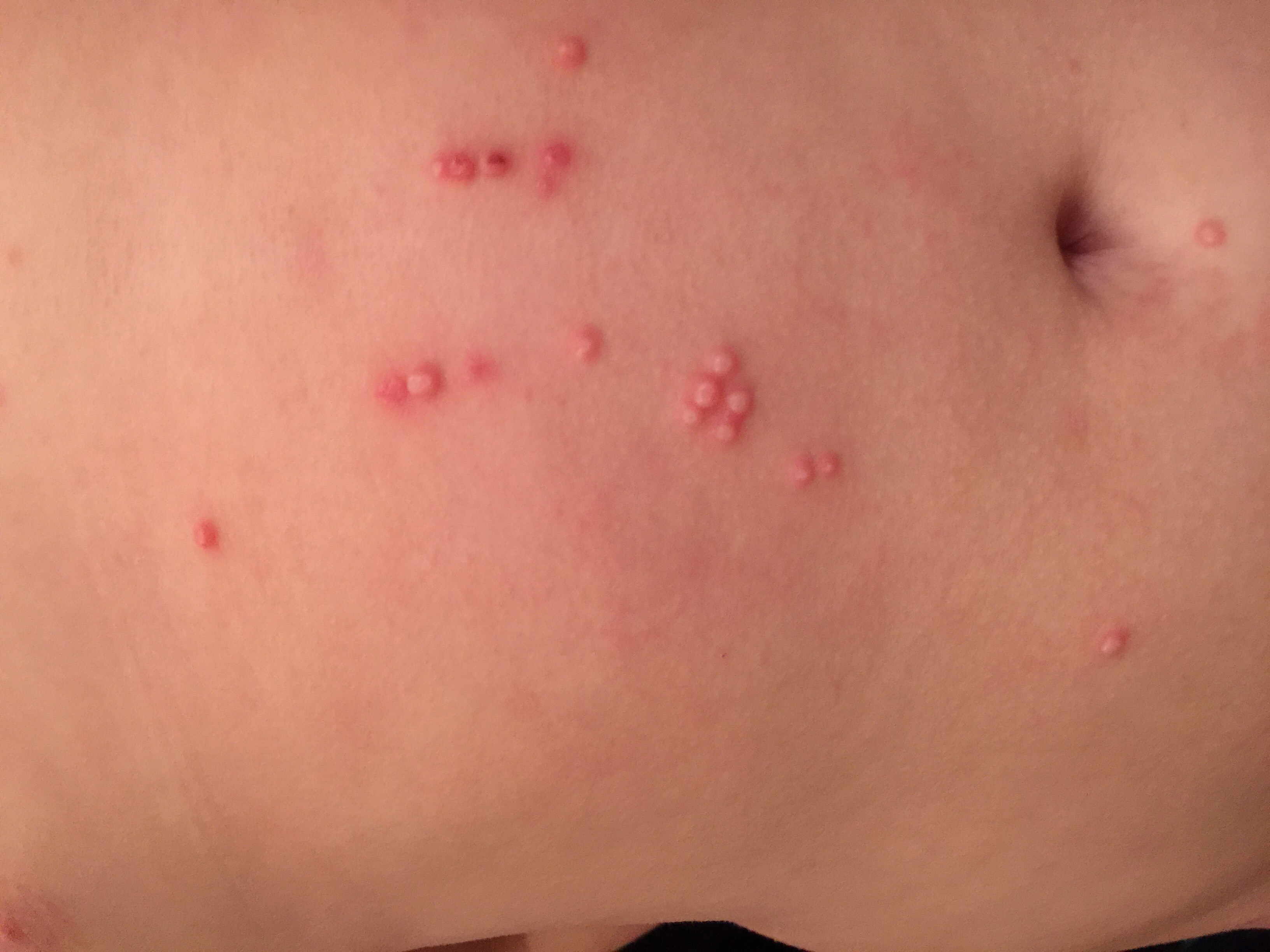 A common, benign viral infection causing small skin bumps