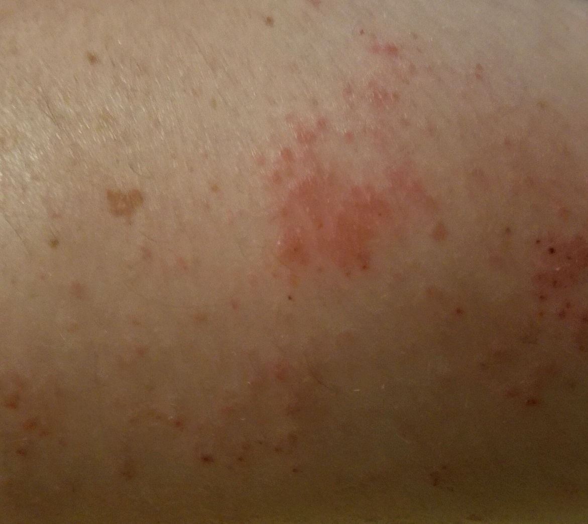 A chronic skin condition characterized by coin-shaped spots on the skin