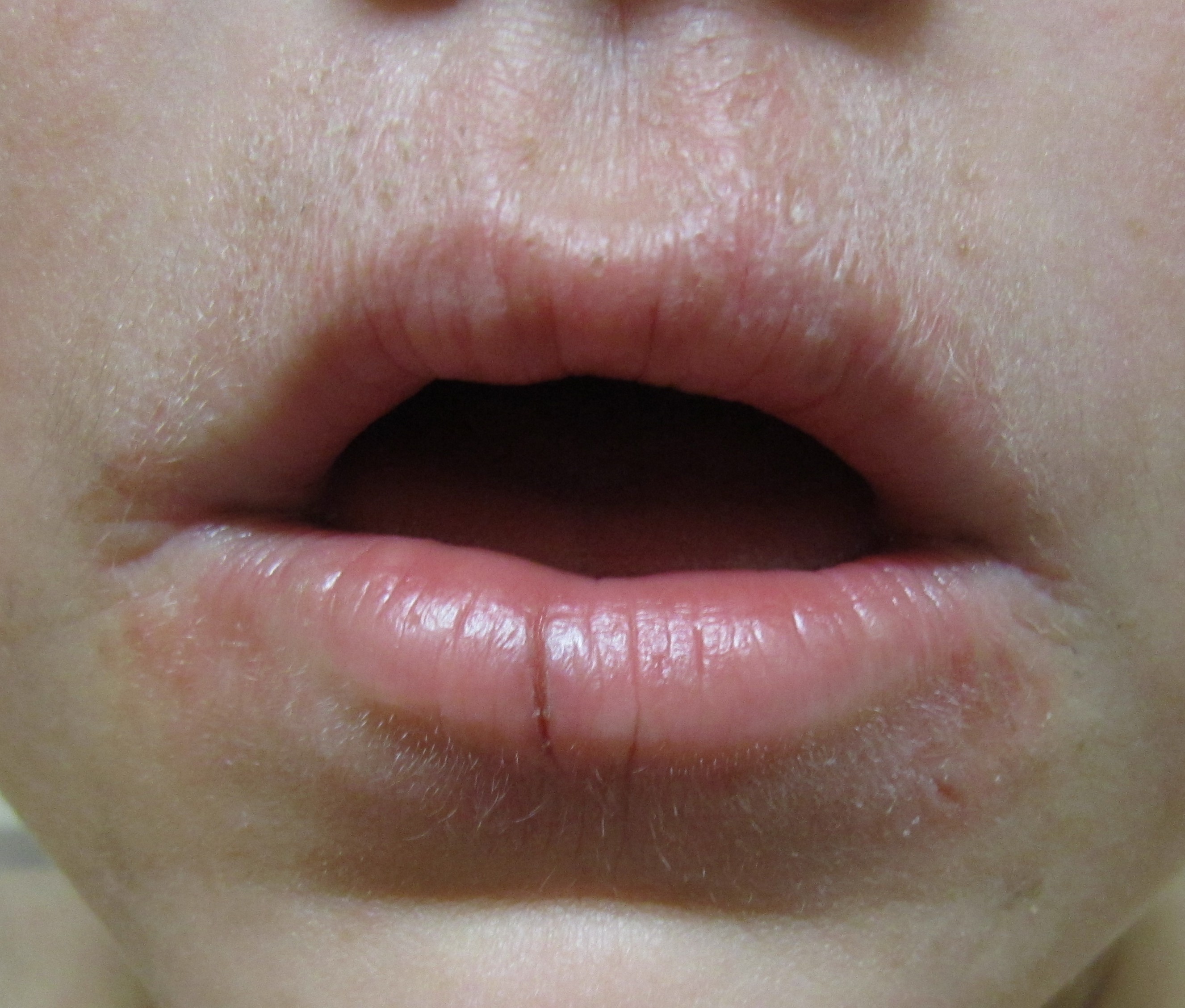 A common skin rash often resembling acne, mainly appearing around the mouth