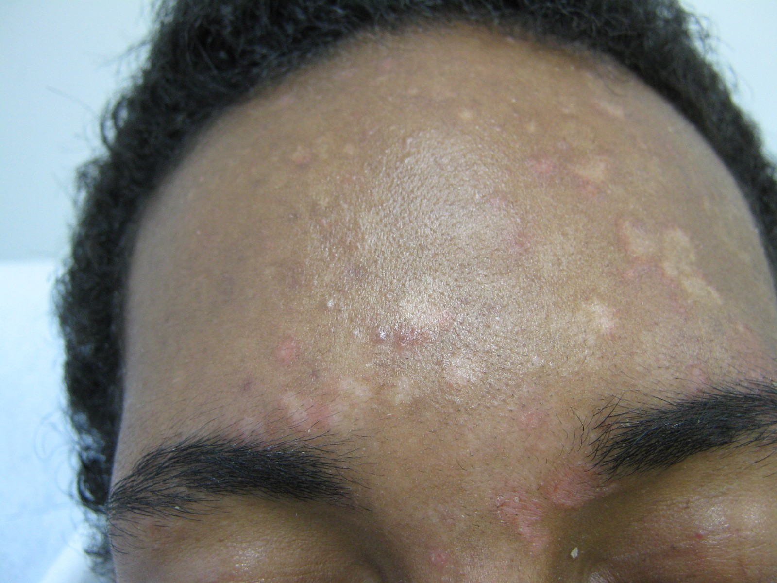 A common, benign skin condition known for distinct rash patterns