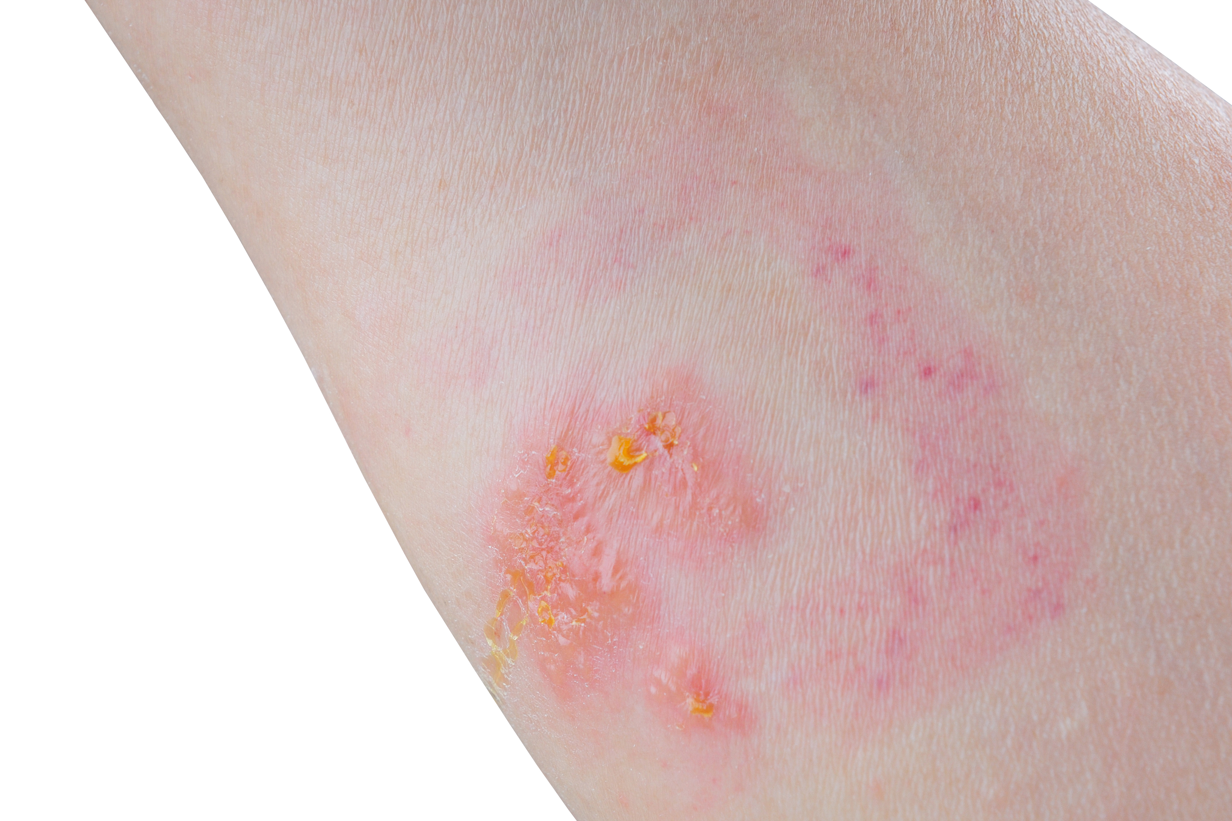 A highly irritating skin rash caused by exposure to plants like poison ivy