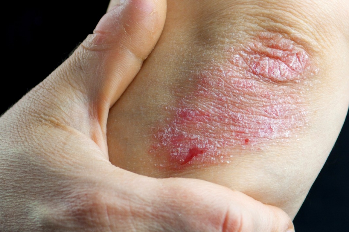 A recurring autoimmune disease causing red, itchy, and scaly patches on the skin