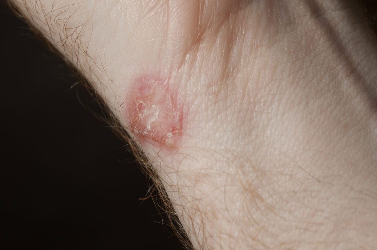 A common fungal infection causing a ring-shaped rash