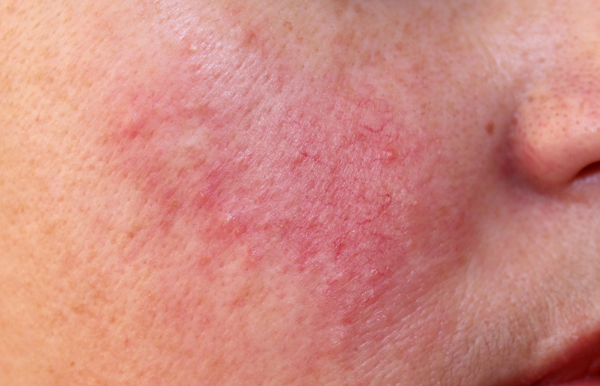 A chronic, inflammatory skin condition causing redness and visible blood vessels in your face