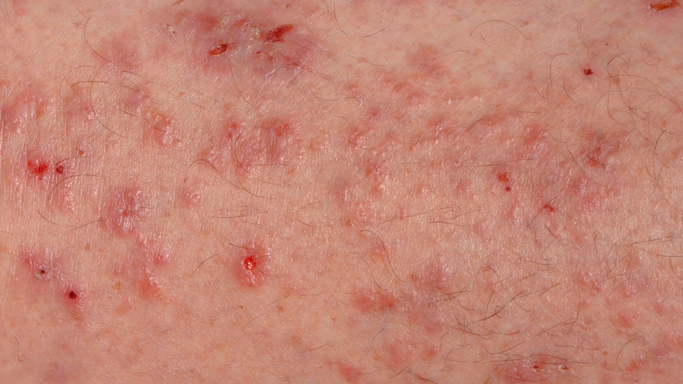 A highly contagious skin infestation caused by a tiny mite