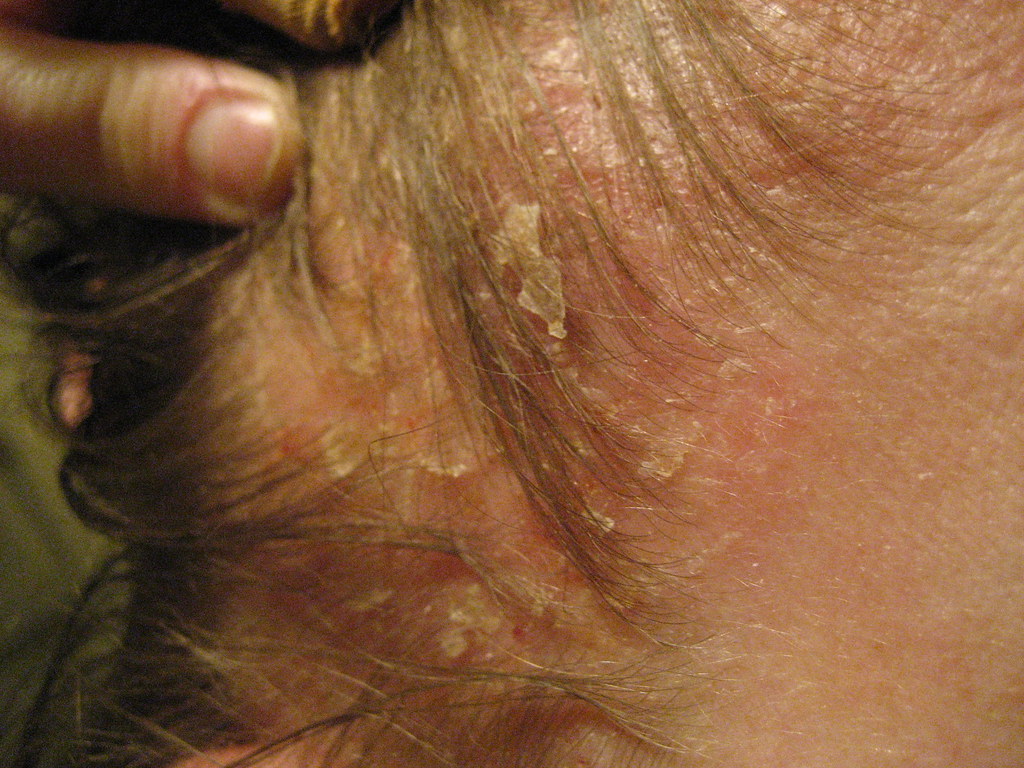 A common and chronic skin condition that causes scaly, itchy patches, and red skin.