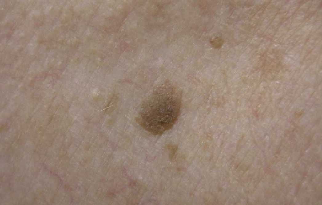 A common, harmless skin growth that appears in adulthood