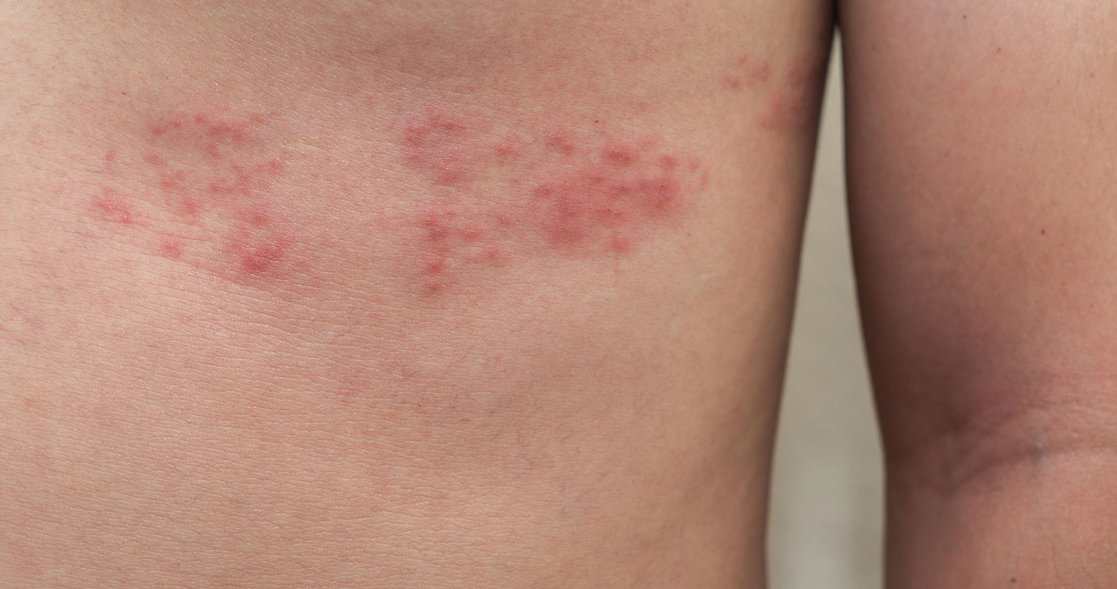 A painful, blistering skin rash caused by the varicella-zoster virus