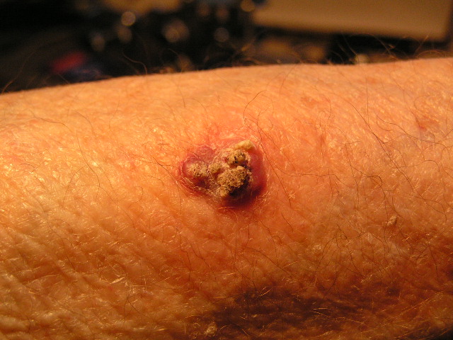 A common form of skin cancer that appears as abnormal, accelerated growth of squamous cells