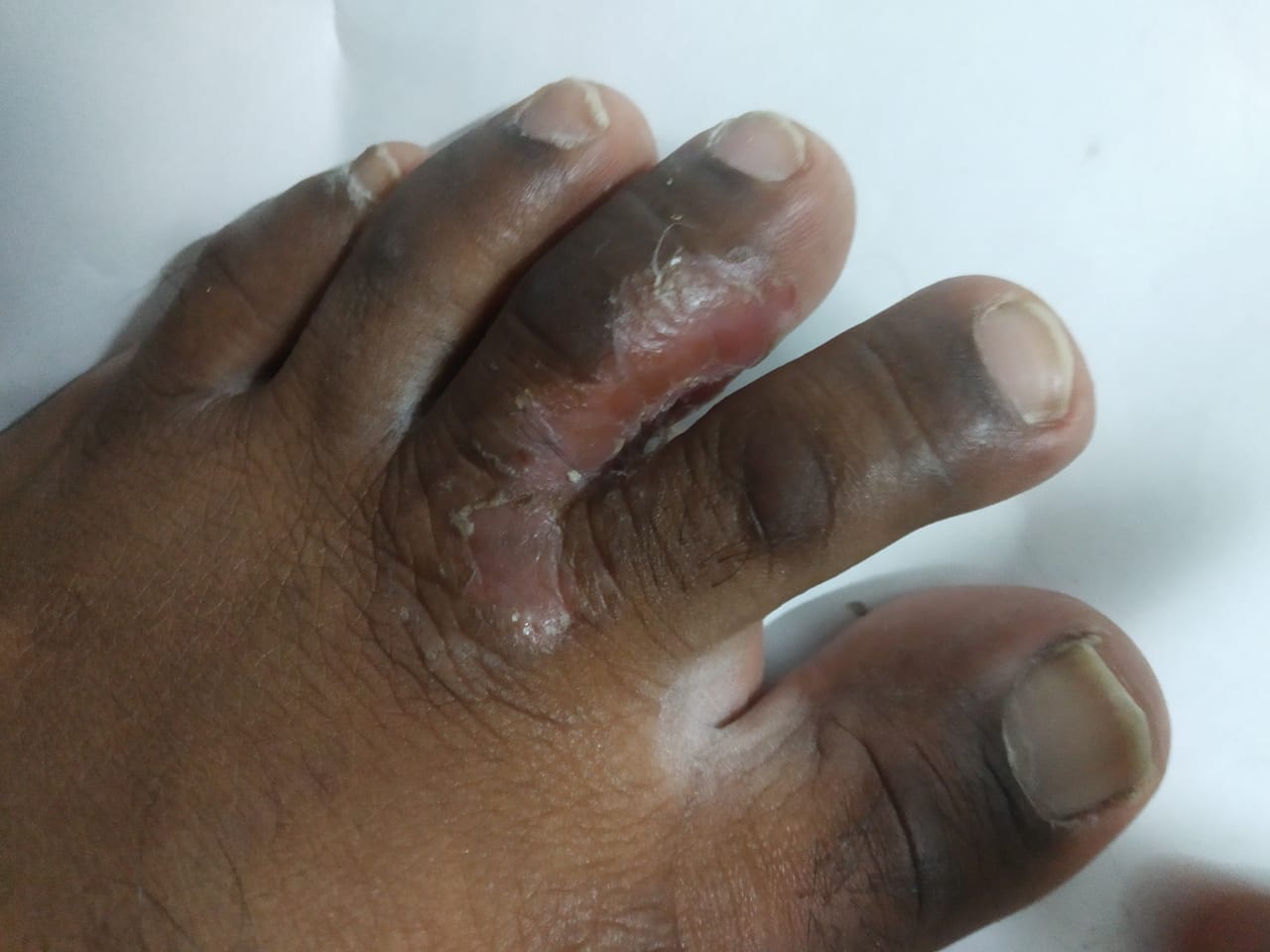 Commonly known as Athlete's Foot, a contagious fungal infection affecting the skin on the feet