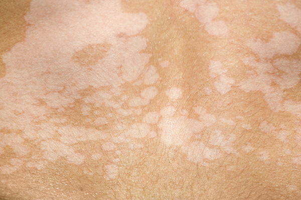 A common fungal infection that disrupts skin pigmentation